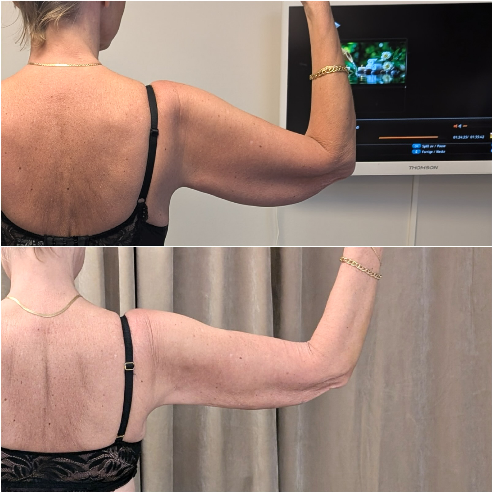 Före och efter fettreducering på överarmar. Före överst, efter underst.